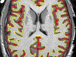 Supporting image for story: Drug offers ‘glimmer of hope’ to patients with progressive MS