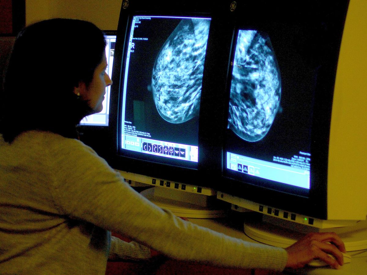 Women who miss first breast cancer appointment have &lsquo;40% higher risk of death&rsquo;