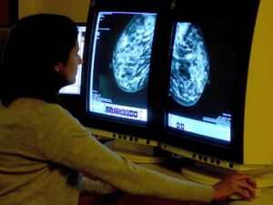 Supporting image for story: Women who miss first breast cancer appointment have ‘40% higher risk of death’