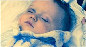 Oscar Webb, 18, months has lost the vision in his right eye after being hit by a propeller from a drone