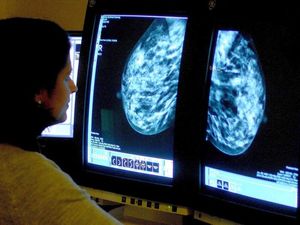 Supporting image for story: Protein discovery could improve therapy options for aggressive breast cancer