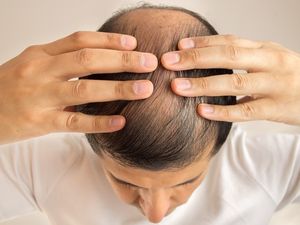 Supporting image for story: The treatment for baldness could lie within immune cells that control inflammation 