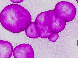 Supporting image for story: World first GM skin replacement for blister boy