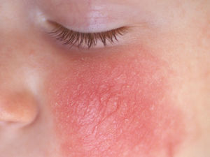 Supporting image for story: Researchers in Walsall sign up first UK patient to eczema trial