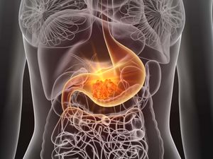 Supporting image for story: Common bacteria ‘fuels millions of cases of stomach cancer across the globe’
