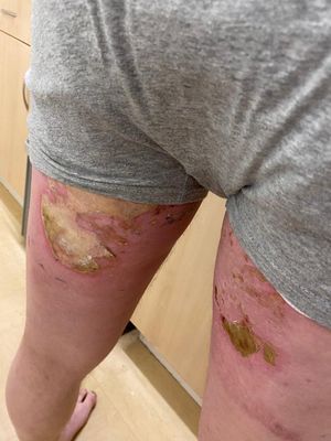 Paul Hickman suffered burns 