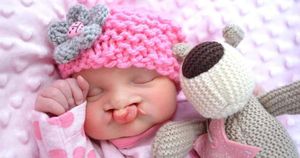 Sophia as a baby. She was born with a cleft palate and is cared for by the West Midlands Cleft Lip and Palate Service.