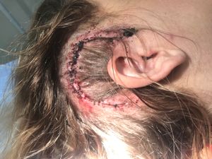 Keri was left with a scar above her ear after surgery