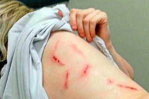 Georgia Manns' injuries