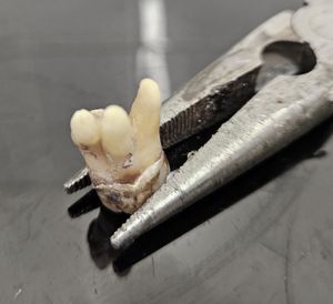 The troublesome tooth after its extraction. Photo: SWNS