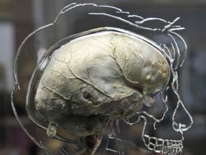 Supporting image for story: Study explores if herpes combined with vaccine can cure childhood brain cancer