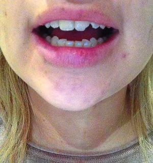Carrie received injuries to her teeth and cuts to her face