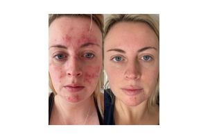 Abigail's results with 47 Skin
