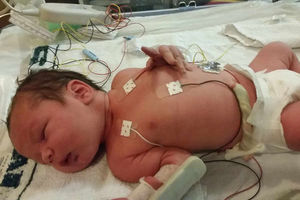 Baby Felix after being born by Caesarian section