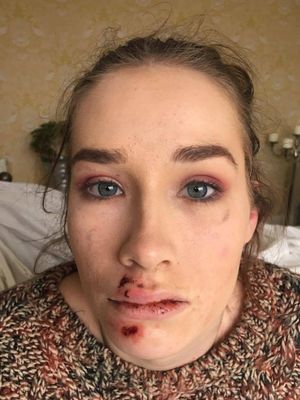 Georgia posted photos of her injuries from the attack on her Facebook account