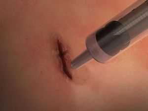 Supporting image for story: This surgical glue can seal wounds in 60 seconds without needing staples or stitches