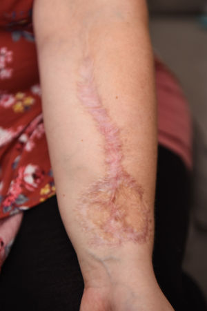 A skin graft was taken from Liz's arm to reconstruct her tongue 