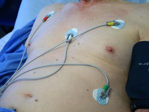 Supporting image for story: Covid-19 linked to worse stroke outcomes – study