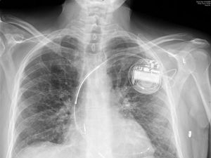 Supporting image for story: Scientists develop battery-free pacemaker powered by heartbeat