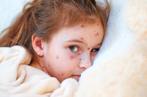 There have been cases of measles in the West Midlands 