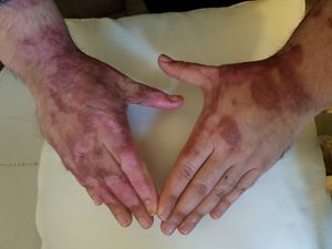 Both of Michael's hands now, after the fire at his home in January