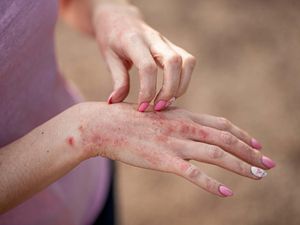 Supporting image for story: NHS rollout of new eczema cream could benefit more than 62,000 people in England