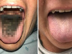 Supporting image for story: A rare case of black hairy tongue has been treated in the US