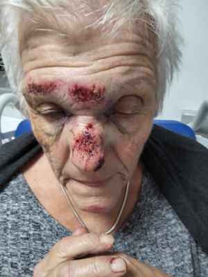 June Jones pictured with cuts and bruises on her face after collapsing