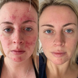 47 Skin 2 Step Treatment Bundle £61