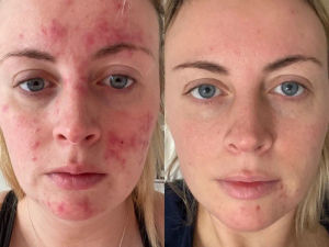 47 Skin 2 Step Treatment Bundle £61