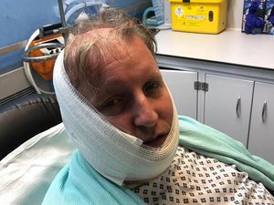 Supporting image for story: Bloxwich 'acid' attack victim 'feels lucky' to escape more serious injury after ordeal 
