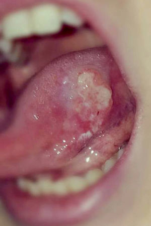 Liz's rebuilt tongue