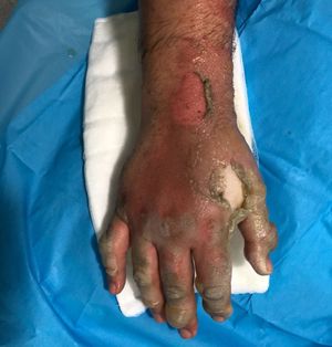 Michael's right hand, four hours after the fire at his home in Perton, South Staffordshire