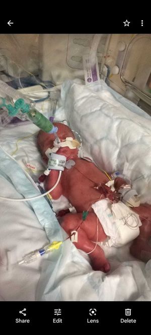 Olivia Jukes Jones when she was born at 28 weeks