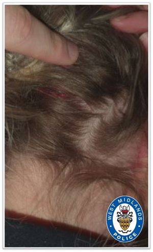 The officer's head injury