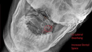 An X-Ray of Connor Edward's skull shows a lateral overhang