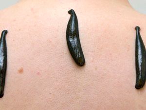 Supporting image for story: Watch how leeches are being used to treat medical problems
