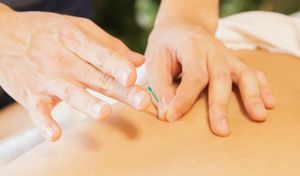 Acupuncture