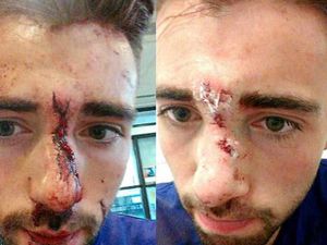 Supporting image for story: Tividale goalkeeper has been in the wars