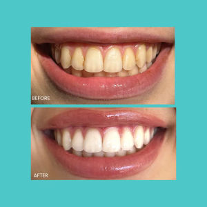 Smilie Before and after