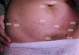 Scars and bruises from each surgery.