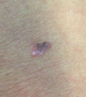 The small blemish that was later discovered to be cancer