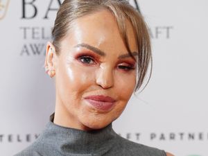 Supporting image for story: Katie Piper shares decision to get artificial eye 16 years after acid attack
