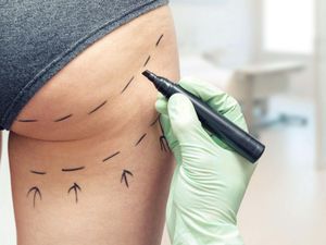 Supporting image for story: Government ‘should immediately ban Brazilian butt lifts’