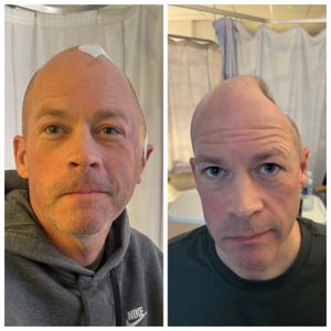 Gareth before and after his operation last week