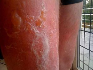 Supporting image for story: Dad's concerns after son 'scalded by McDonald's drink'