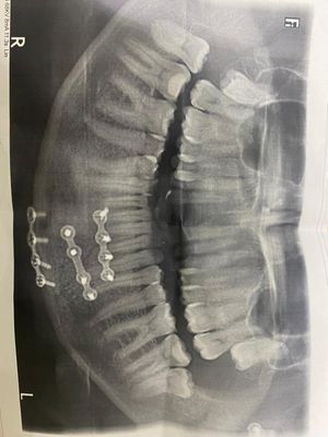 An x-ray of Ruth's jaw following the crash.