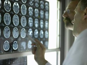 Supporting image for story: AI could spot Alzheimer’s in MRI scans up to a decade before symptoms show