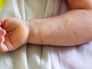 Supporting image for story: Urgent stem cell plea for toddler with rare blood disorder